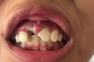 Di SDI Bakateu Malaka, Gigi Siswa Copot Akibat Kelalaian Guru, Orang Tua Siswa Lapor Polisi 